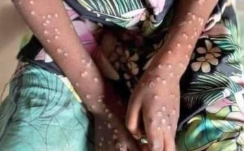 La variole du singe se propage en Côte d’Ivoire : 32 cas confirmés et une surveillance accrue